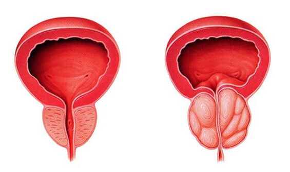 Próstata normal e inflamada (prostatitis)