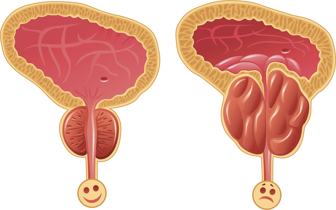 Cómo determinar la presencia de prostatitis