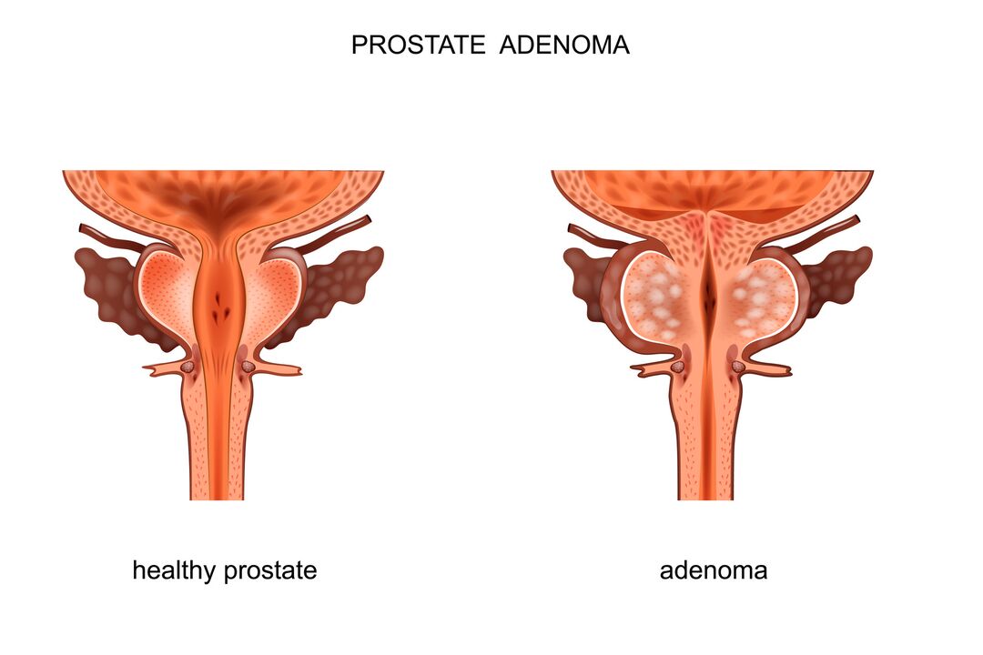 Próstata y adenoma saludables