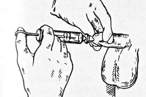 instilaciones para la prostatitis