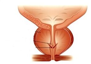 prostatitis y su tratamiento con medicamentos