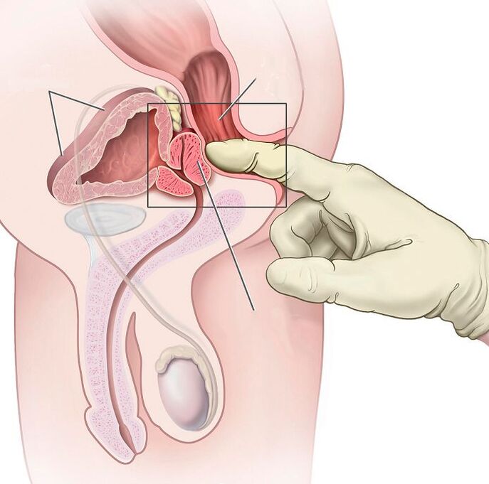Masaje prostático para el tratamiento de la prostatitis.