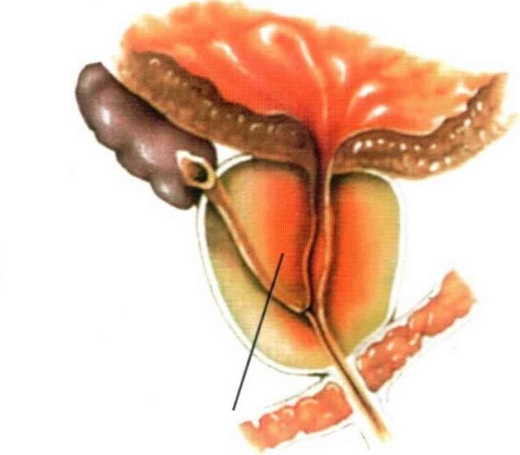 Inflamación del tejido prostático en la prostatitis crónica.